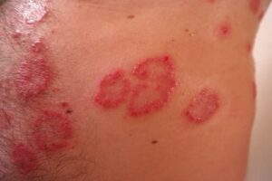 Manchas por la psoriasis que se puede curar con aceites esenciales